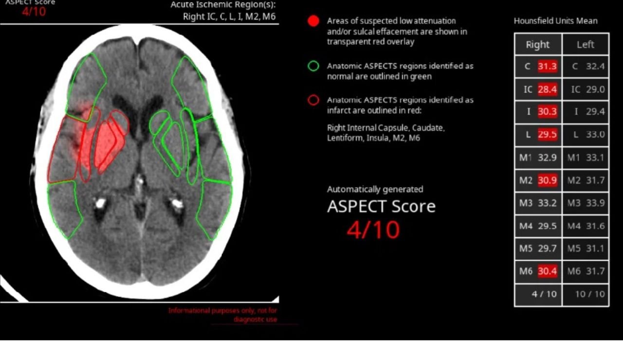 Avicenna.AI collects €7 million series A for its AI-driven critical radiology screening platform