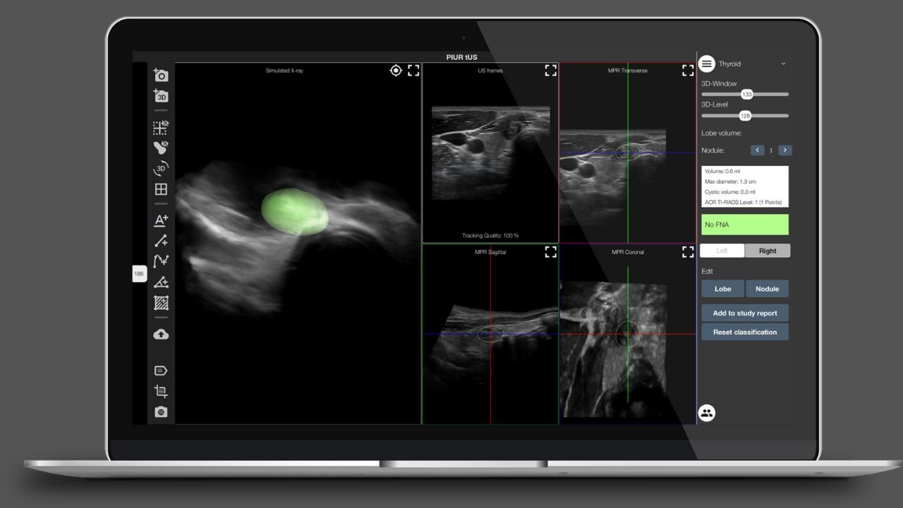 Austria's Piur Imaging raises €4.9 million to bring vendor-independent tomographic 3D ultrasound solution to the US